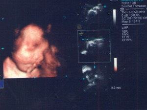 3D ultrazvuk – nejlepší  filmový trhák v těhotenství aneb Naše první video
