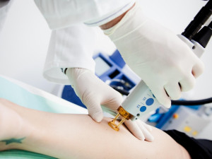 RRC Clinic - Dermatologie - Laserová sklerotizace metličkových varixů