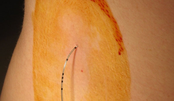 Zavedená epidurální anestezie