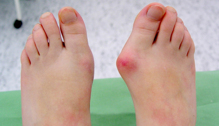 Vbočený palec. Levá noha je zdravá, pravá nemocná