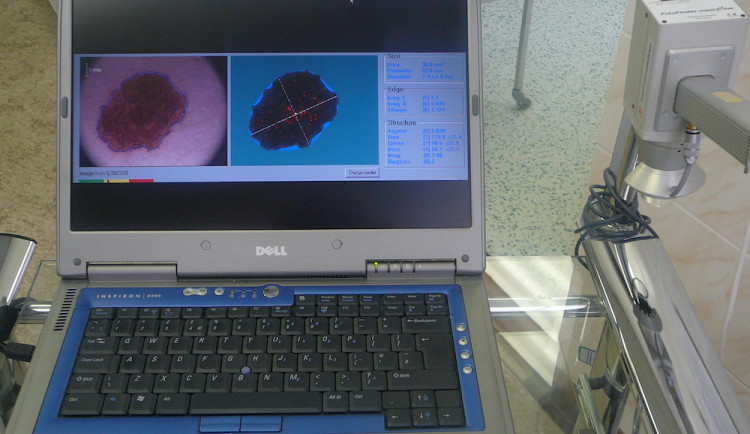 Vyšetření mateřských znamének a pih robotickým dermatoskopem je prevencí rakoviny kůže