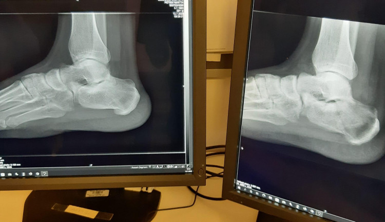 V brněnské nemocnici mají rentgeny s nízkou radiační zátěží