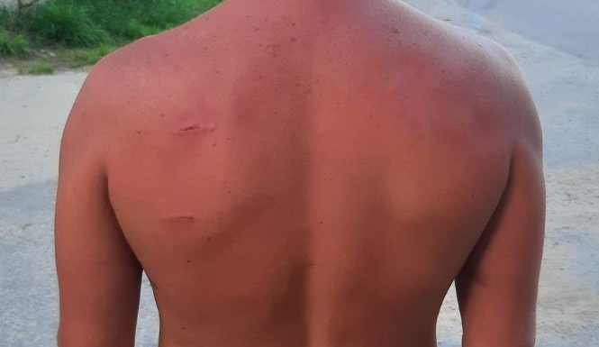 Do muže najel na makovém poli kombajn. Vyvázl jen s pár šrámy