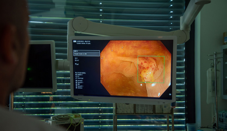 Umělá inteligence už zachraňuje lidské životy. Lékařům z Fakultní nemocnice pomáhá odhalit nádory tlustého střeva