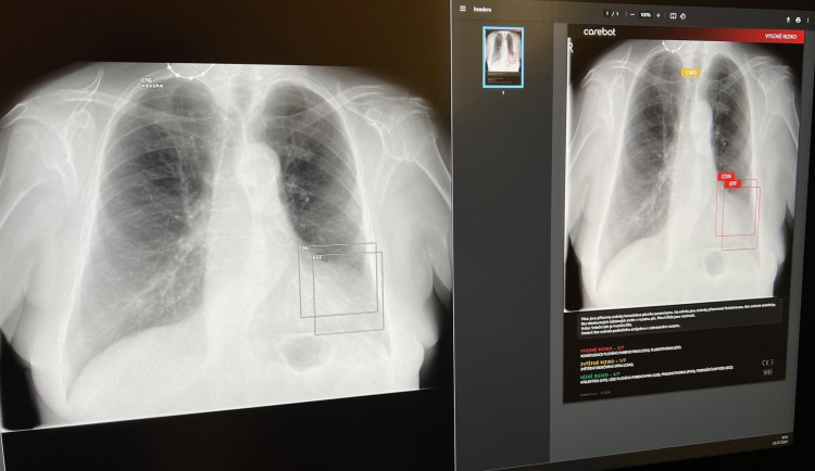 V táborské nemocnici pomáhá lékařům s diagnostikou plic umělá inteligence