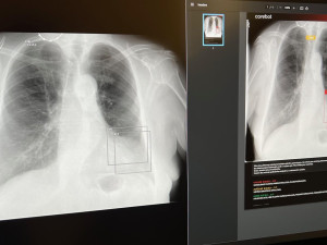 V táborské nemocnici pomáhá lékařům s diagnostikou plic umělá inteligence