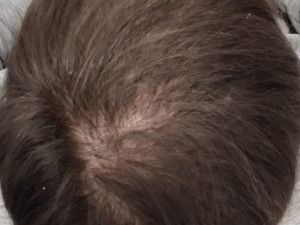 Třetí návštěva muže s alopecii areata.