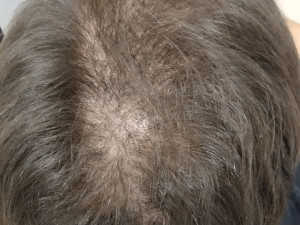 První návštěva muže s alopecii areata.