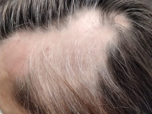 Alopecie areata třetí návštěva