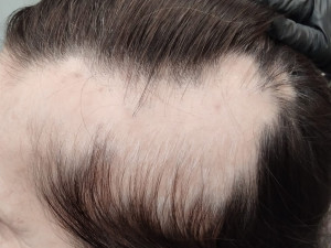 Alopecie areata první návštěva