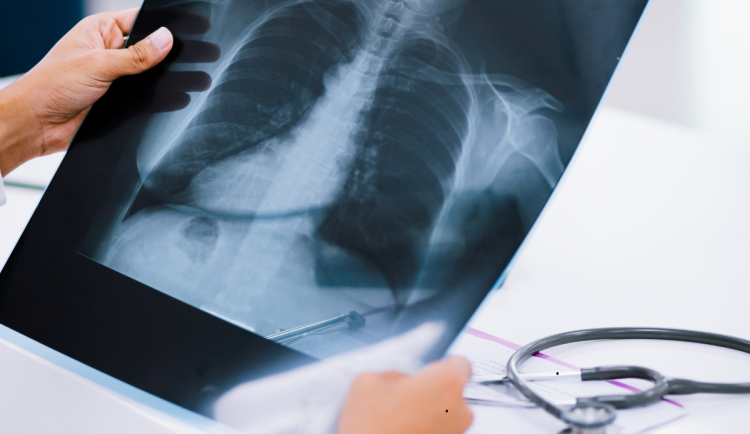 Rakovina plic nebolí. Díky screeningu v Hradci žijí desítky lidí dál