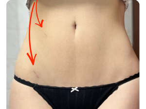 Ani velká gynekologická operace nemusí být na těle znát.