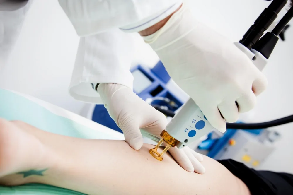 RRC Clinic - Dermatologie - Laserová sklerotizace metličkových varixů