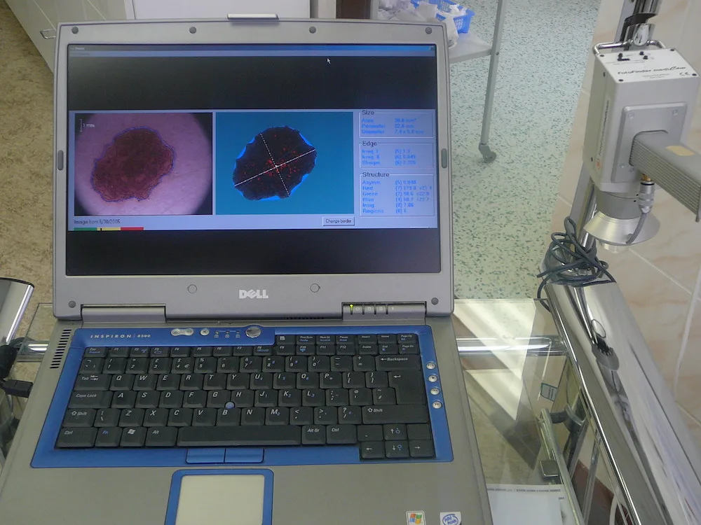 Vyšetření mateřských znamének a pih robotickým dermato-skopem – prevence rakoviny kůže. Nic mu neunikne. Sca-nuje, analyzuje, ukládá data