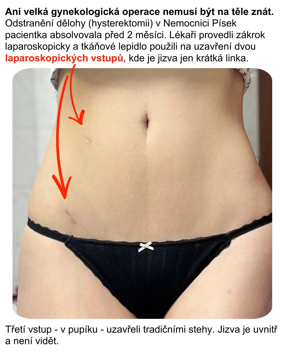 Ani velká gynekologická operace nemusí být na těle znát.
