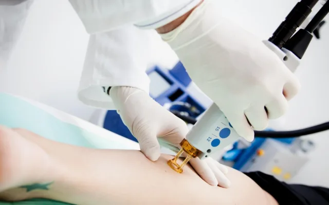 RRC Clinic - Dermatologie - Laserová sklerotizace metličkových varixů