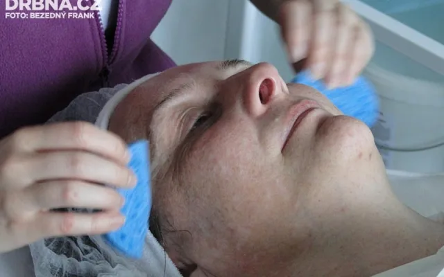 Omlazení obličeje bipolární radiofrekvencí v Amaryllis Beauty Institutu
