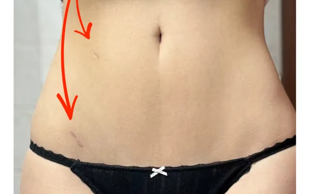 Ani velká gynekologická operace nemusí být na těle znát.