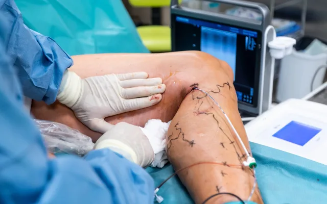 Písečtí chirurgové používají na křečové žíly laser.