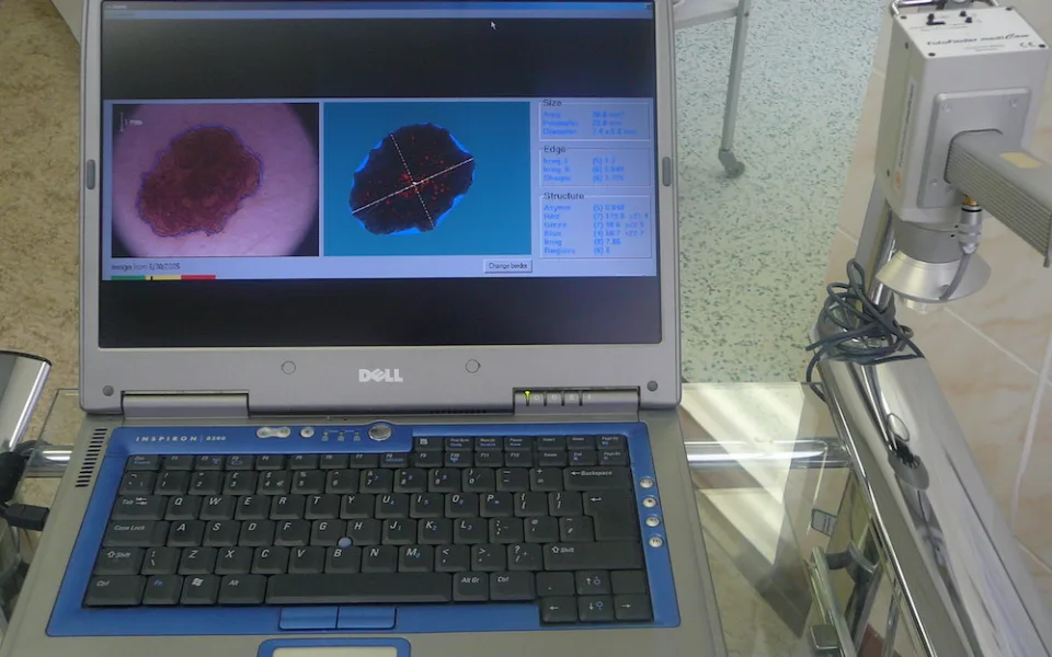 Vyšetření mateřských znamének a pih robotickým dermato-skopem – prevence rakoviny kůže. Nic mu neunikne. Sca-nuje, analyzuje, ukládá data