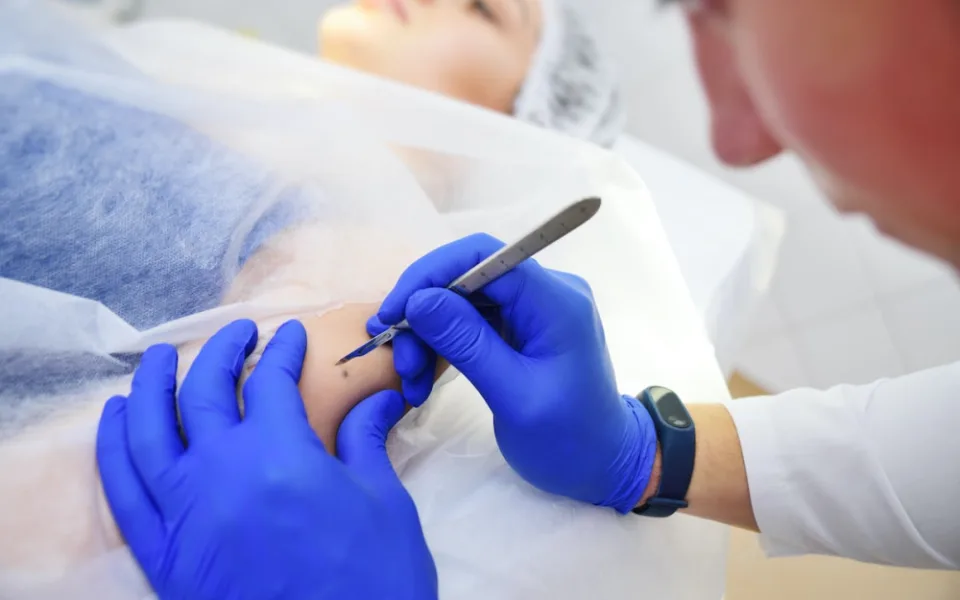 Nechte si po létu zkontrolovat znaménka, doporučují dermatologové