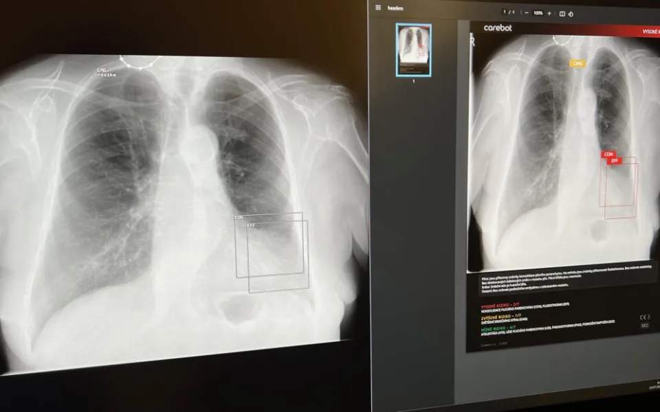 V táborské nemocnici pomáhá lékařům s diagnostikou plic umělá inteligence
